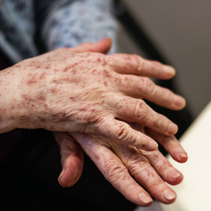 Porfiria – przyczyny, objawy, diagnostyka i leczenie