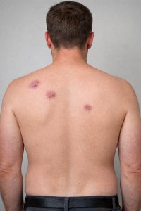 Łupież różowy Giberta – przyczyny, objawy, leczenie