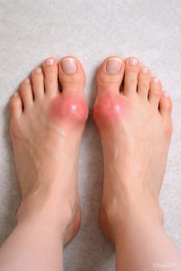 Dna moczanowa (podagra) – objawy, przyczyny, dieta i leczenie