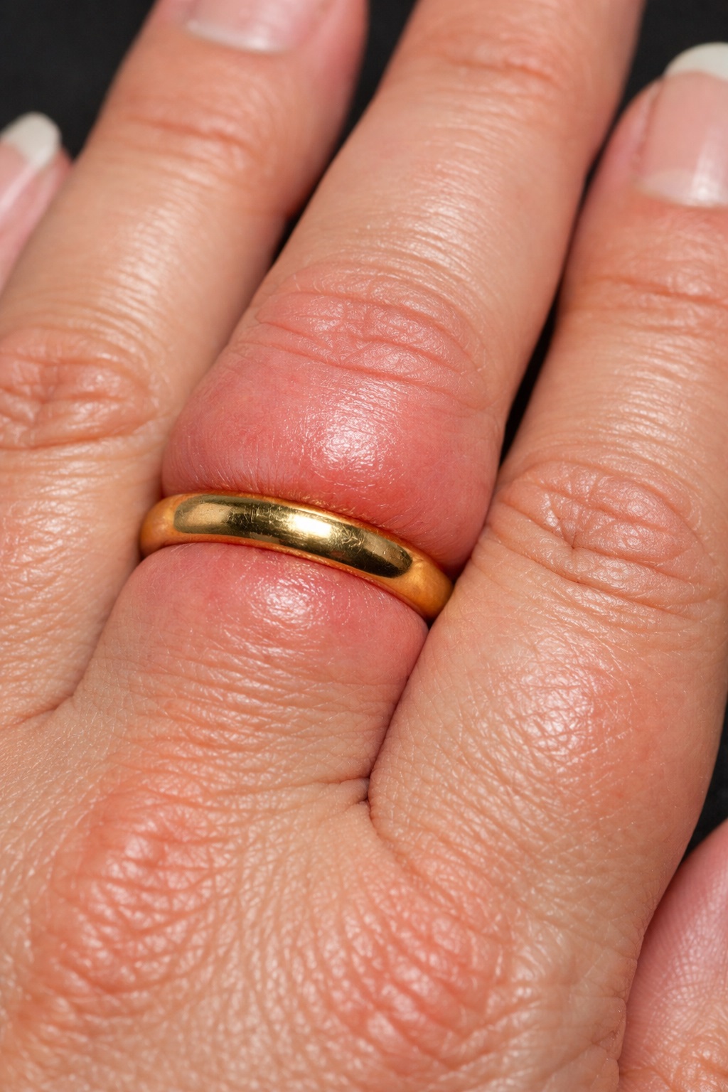 Opuchnięte palce u rąk – przyczyny, cena badań i diagnostyka