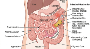 Niedrożność jelit – objawy, przyczyny, rodzaje i metody leczenia