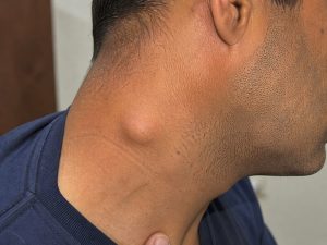 Powiększone węzły chłonne - Przyczyny, objawy i kiedy udać się do lekarza