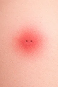 Ugryzienie pająka – objawy, leczenie i cena diagnostyki